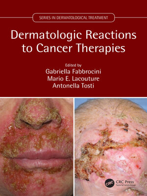 cover image of Dermatologic Reactions to Cancer Therapies
